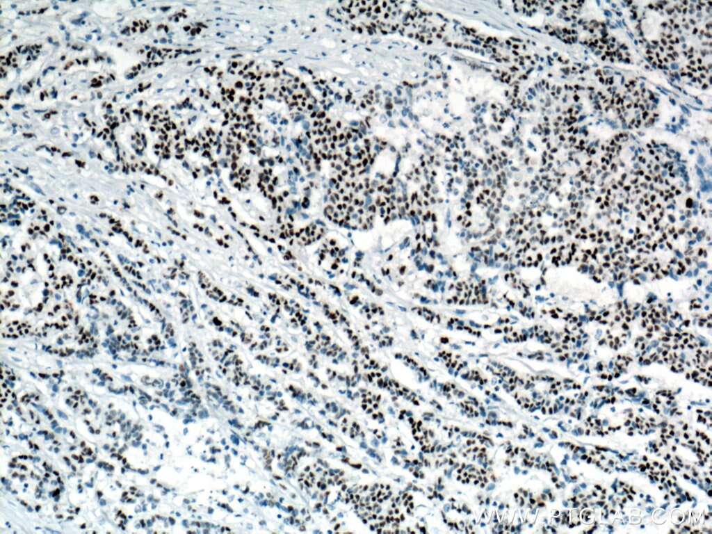 Immunohistochemistry (IHC) staining of human colon cancer tissue using P53 Monoclonal antibody (60283-2-Ig)