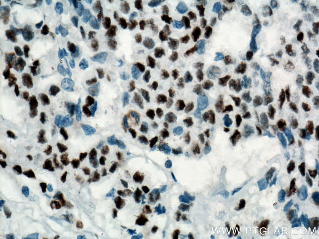 Immunohistochemistry (IHC) staining of human colon cancer tissue using P53 Monoclonal antibody (60283-2-Ig)