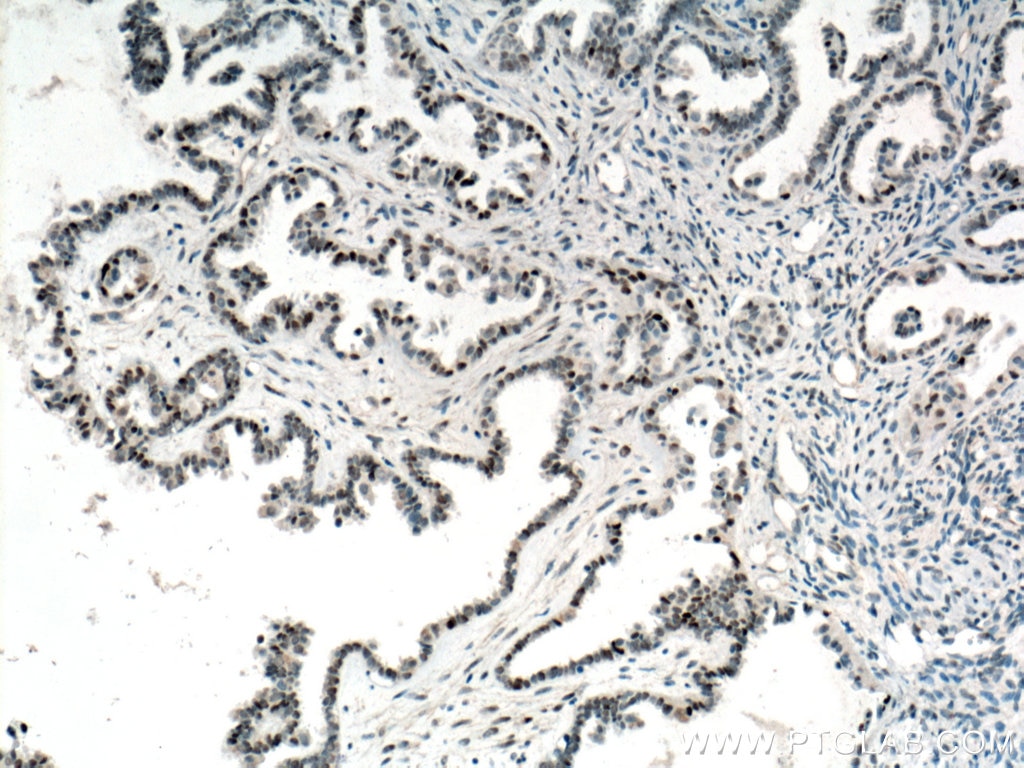 IHC staining of human ovary tumor using 60283-2-Ig