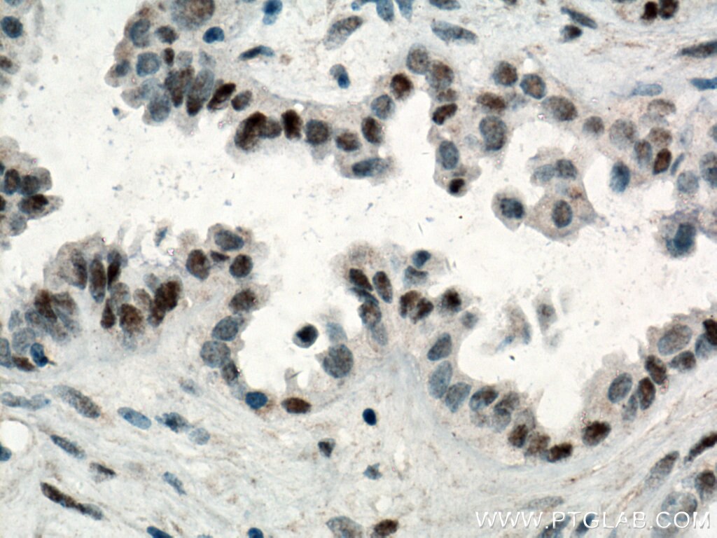 Immunohistochemistry (IHC) staining of human ovary tumor tissue using P53 Monoclonal antibody (60283-2-Ig)