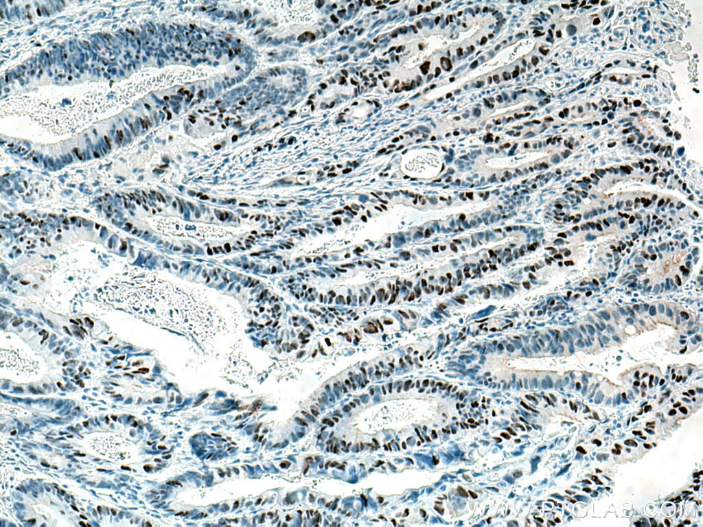 Immunohistochemistry (IHC) staining of human colon cancer tissue using P53 Monoclonal antibody (60283-2-Ig)