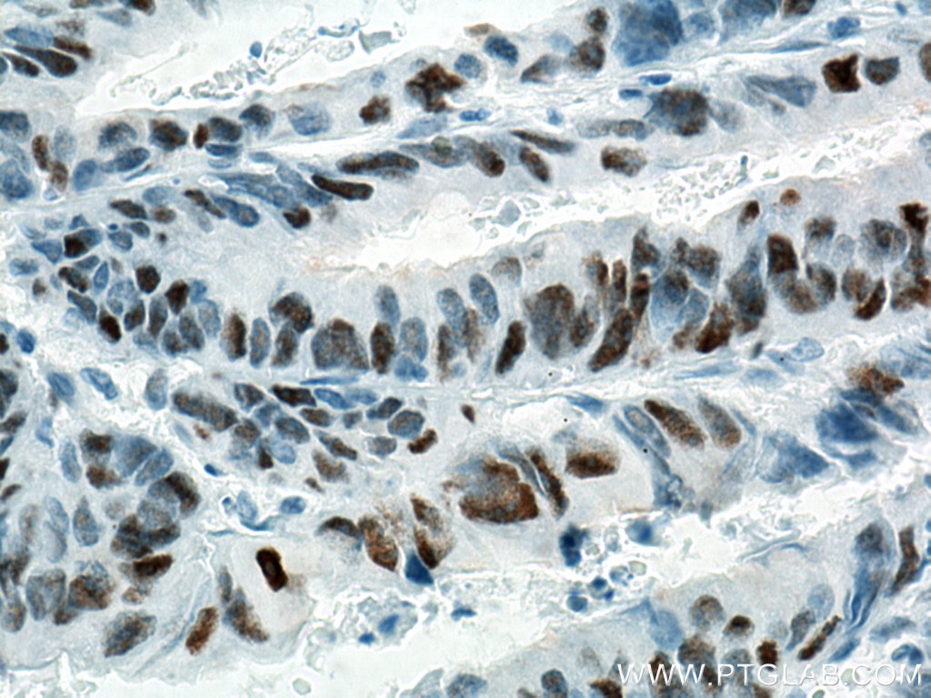 Immunohistochemistry (IHC) staining of human colon cancer tissue using P53 Monoclonal antibody (60283-2-Ig)