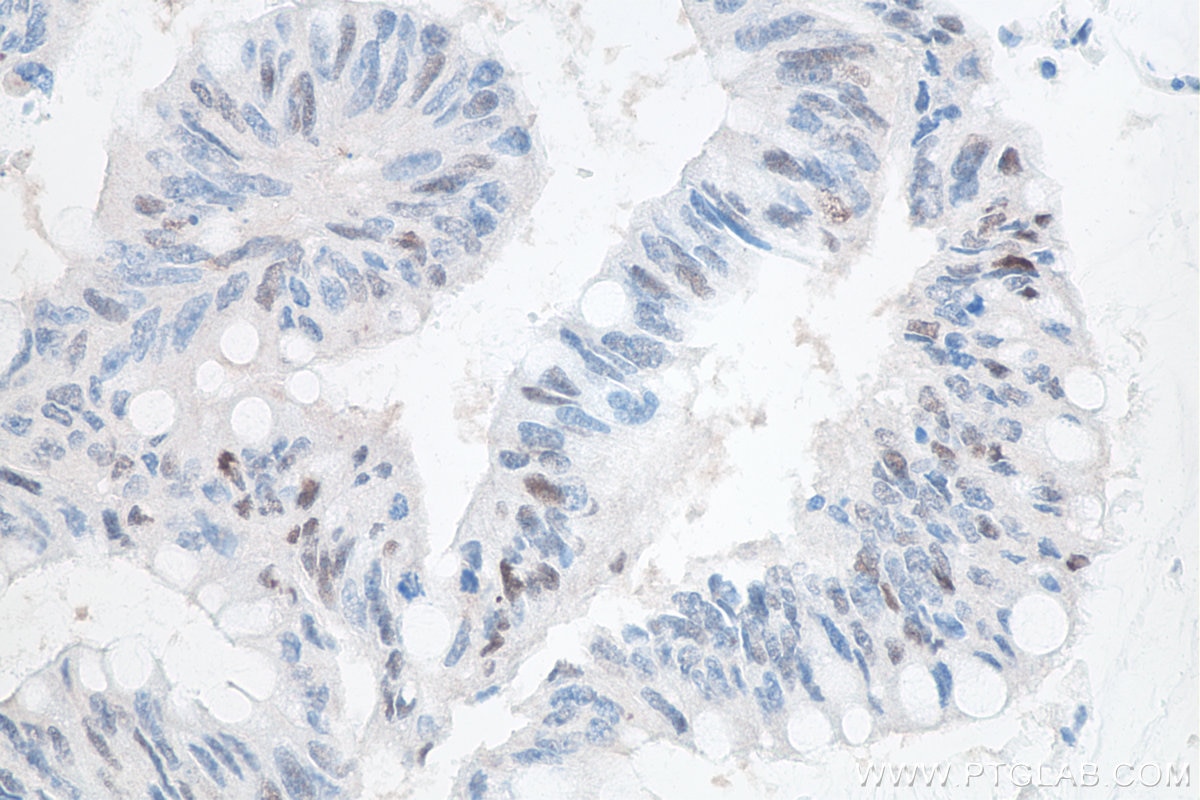Immunohistochemistry (IHC) staining of human colon cancer tissue using P53 Monoclonal antibody (60283-2-Ig)