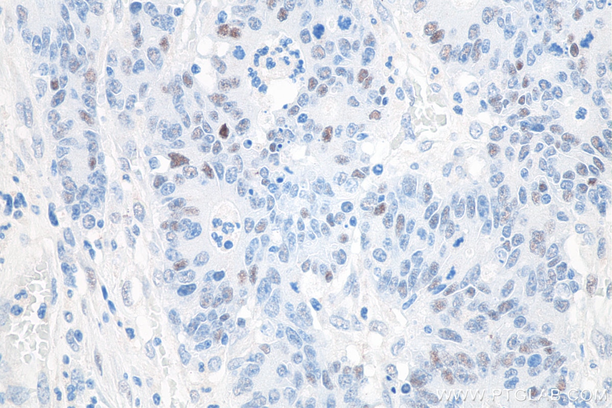 Immunohistochemistry (IHC) staining of human colon cancer tissue using P53 Monoclonal antibody (60283-2-Ig)