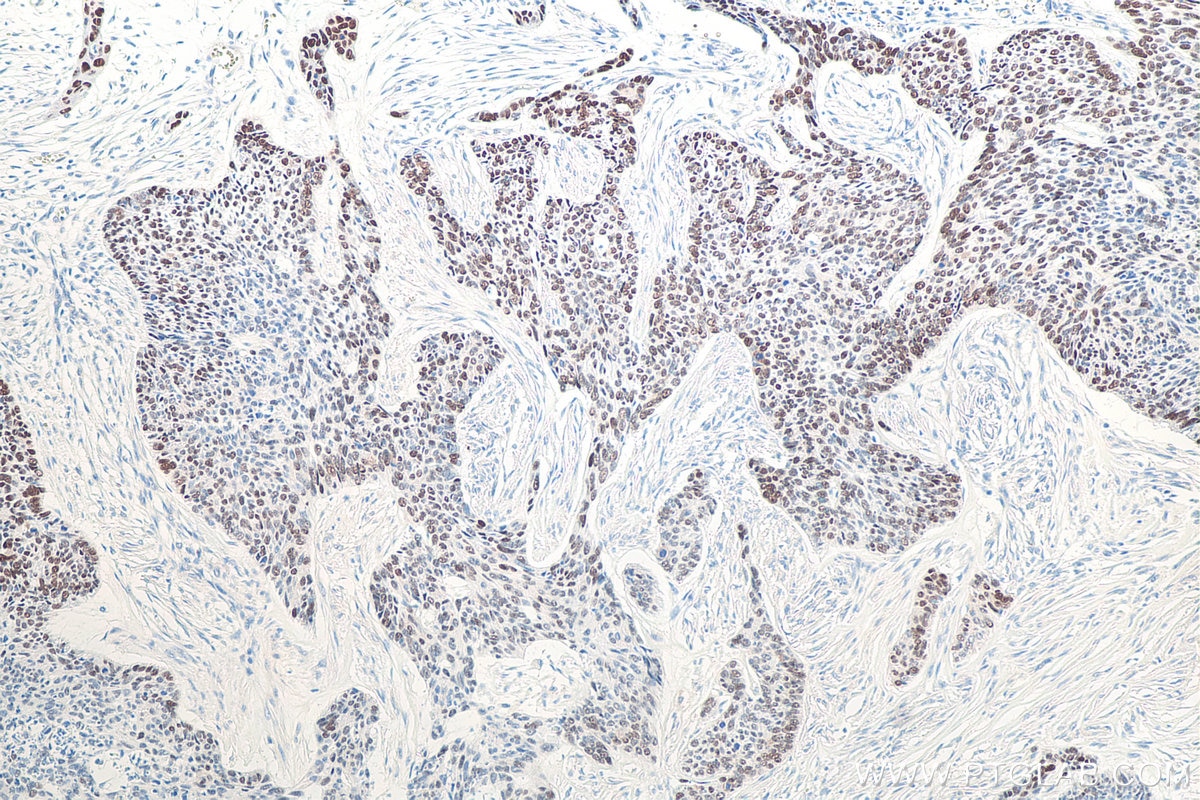 Immunohistochemistry (IHC) staining of human skin cancer tissue using P53 Monoclonal antibody (60283-2-Ig)