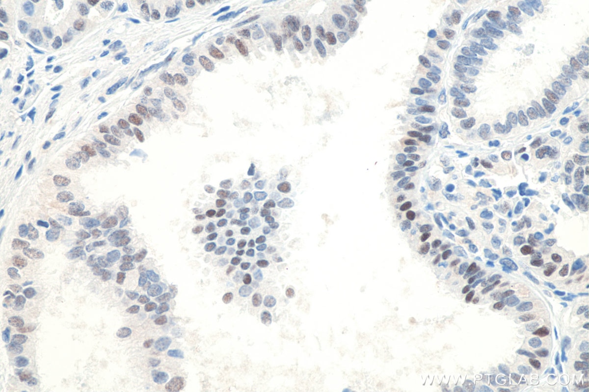 Immunohistochemistry (IHC) staining of human ovary tumor tissue using P53 Monoclonal antibody (60283-2-Ig)