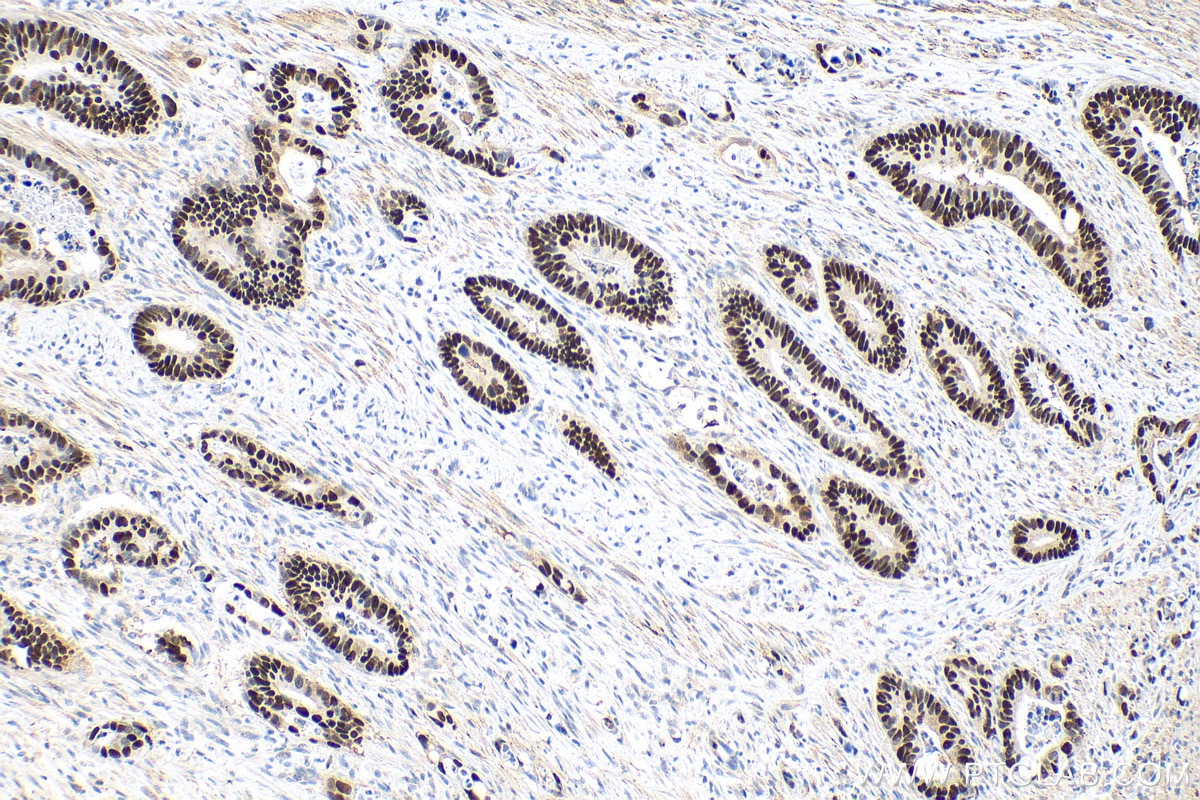 Immunohistochemistry (IHC) staining of human colon cancer tissue using P53 Monoclonal antibody (60283-2-Ig)