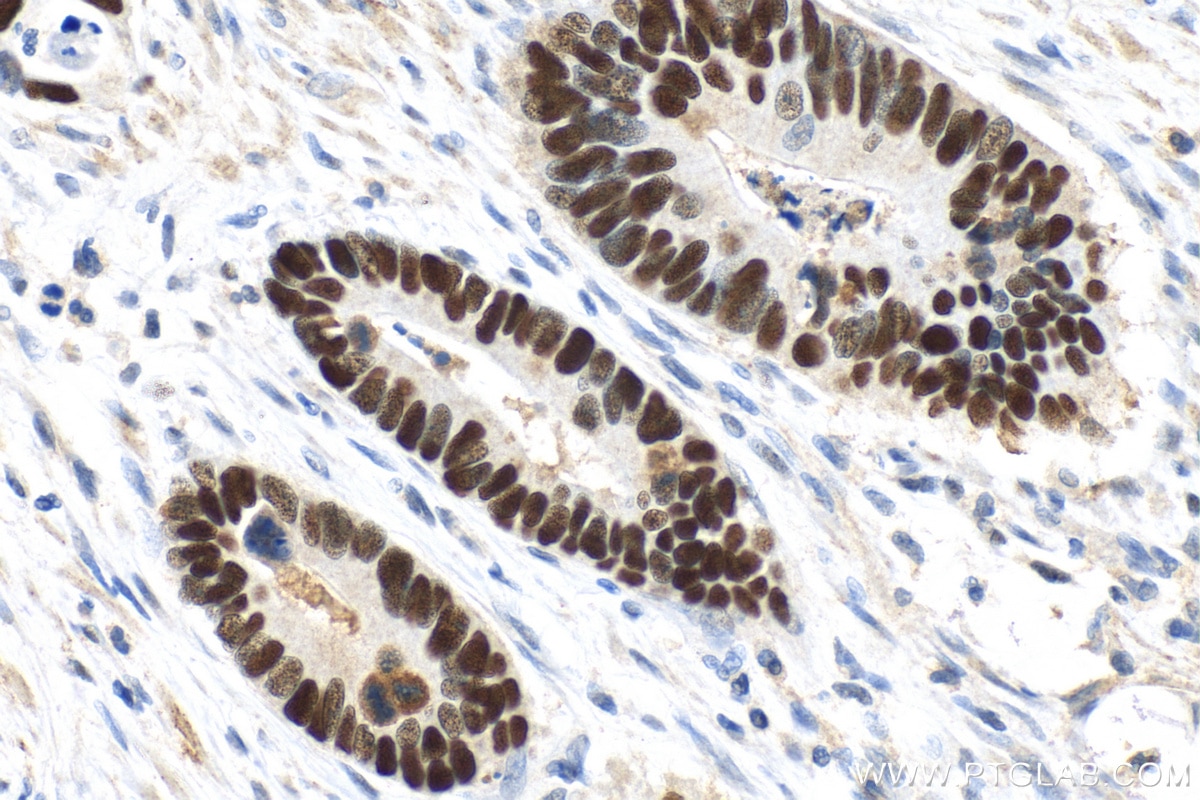 Immunohistochemistry (IHC) staining of human colon cancer tissue using P53 Monoclonal antibody (60283-2-Ig)