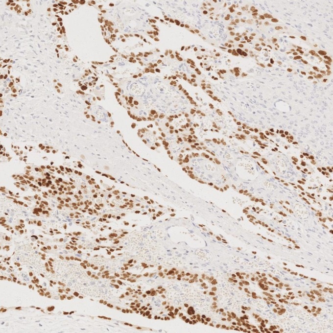Immunohistochemistry (IHC) staining of human ovary cancer tissue using P53 Monoclonal antibody (60283-2-Ig)