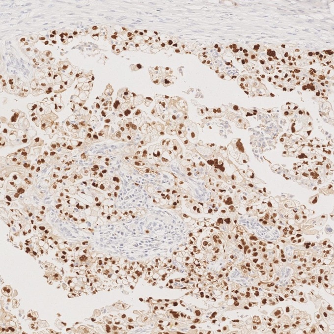 Immunohistochemistry (IHC) staining of human ovary cancer tissue using P53 Monoclonal antibody (60283-2-Ig)
