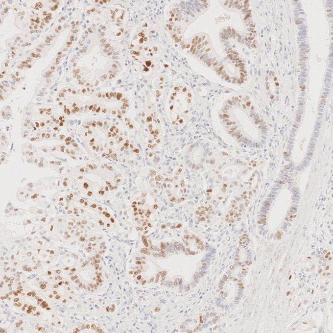 Immunohistochemistry (IHC) staining of human pancreas cancer tissue using P53 Monoclonal antibody (60283-2-Ig)