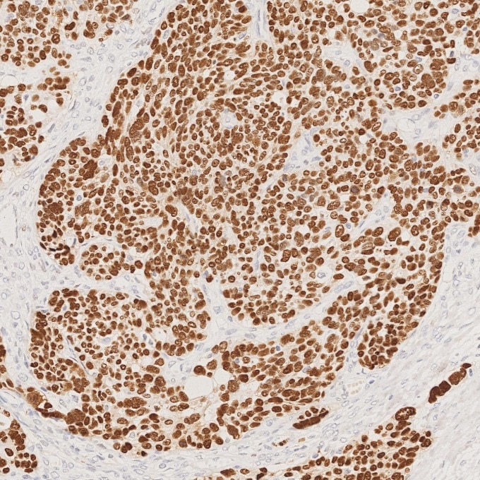 Immunohistochemistry (IHC) staining of human ovary cancer tissue using P53 Monoclonal antibody (60283-2-Ig)