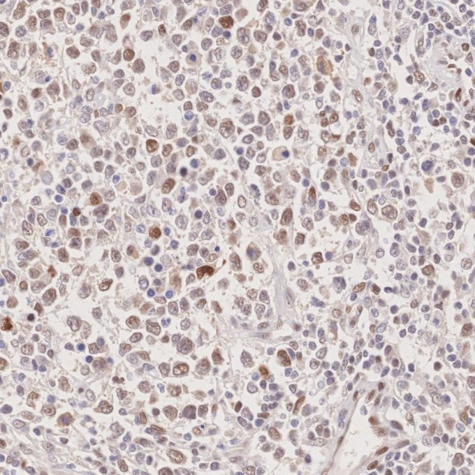 Immunohistochemistry (IHC) staining of human lymphoma tissue using P53 Monoclonal antibody (60283-2-Ig)