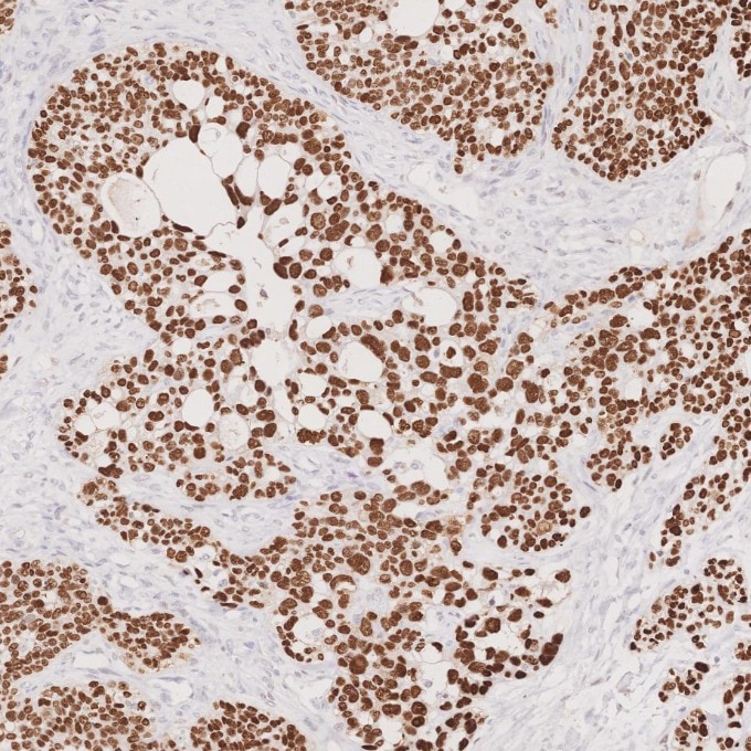 Immunohistochemistry (IHC) staining of human ovary cancer tissue using P53 Monoclonal antibody (60283-2-Ig)