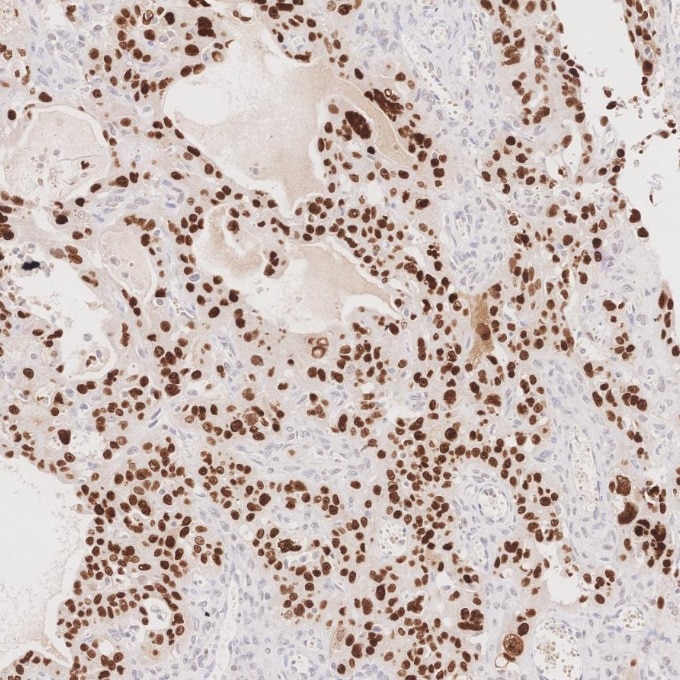 Immunohistochemistry (IHC) staining of human ovary cancer tissue using P53 Monoclonal antibody (60283-2-Ig)