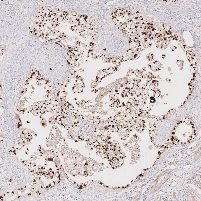 Immunohistochemistry (IHC) staining of human ovary cancer tissue using P53 Monoclonal antibody (60283-2-Ig)