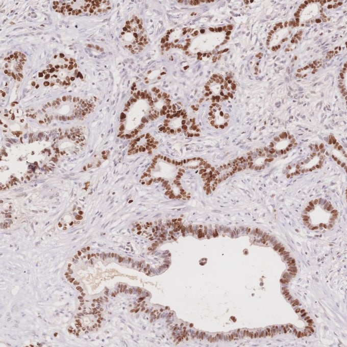 Immunohistochemistry (IHC) staining of human pancreas cancer tissue using P53 Monoclonal antibody (60283-2-Ig)