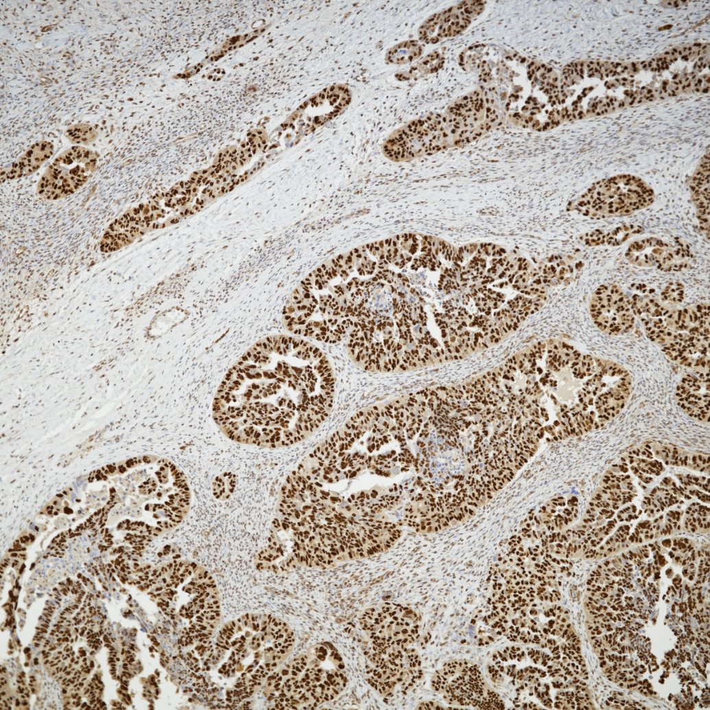 Immunohistochemistry (IHC) staining of human ovarian cancer using P53 Recombinant monoclonal antibody (80077-1-RR)