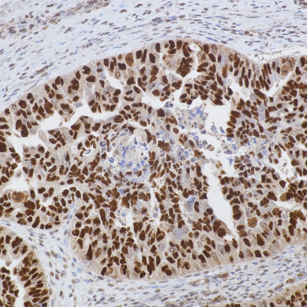 Immunohistochemistry (IHC) staining of human ovarian cancer using P53 Recombinant monoclonal antibody (80077-1-RR)