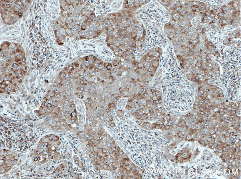 Immunohistochemistry (IHC) staining of human breast cancer tissue using DDX6 Polyclonal antibody (14632-1-AP)