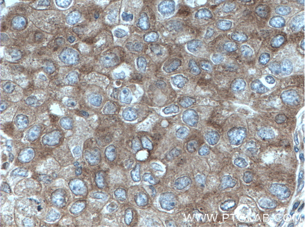 Immunohistochemistry (IHC) staining of human breast cancer tissue using DDX6 Polyclonal antibody (14632-1-AP)