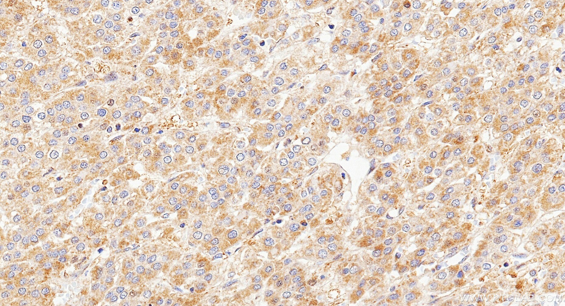 IHC staining of Human Hepatocellular cancer using 87037-1-RR (same clone as 87037-1-PBS) Immunohistochemistry (IHC) staining of Human Hepatocellular cancer using P5CS Recombinant monoclonal antibody (87037-1-RR)