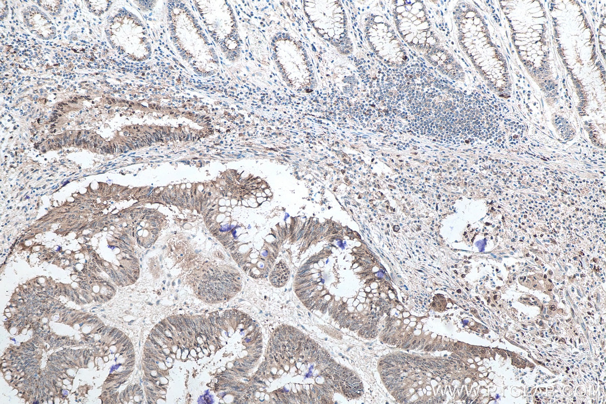 IHC staining of human colon cancer using 66184-1-Ig Immunohistochemistry (IHC) staining of human colon cancer tissue using P62/SQSTM1 Monoclonal antibody (66184-1-Ig)