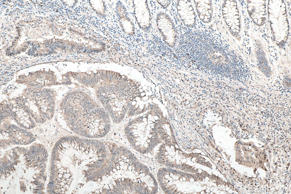 Immunohistochemistry (IHC) staining of human colon cancer tissue using P62,SQSTM1 Monoclonal antibody (66184-1-Ig)