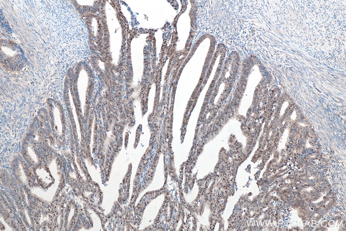 IHC staining of human endometrial cancer using 66184-1-Ig