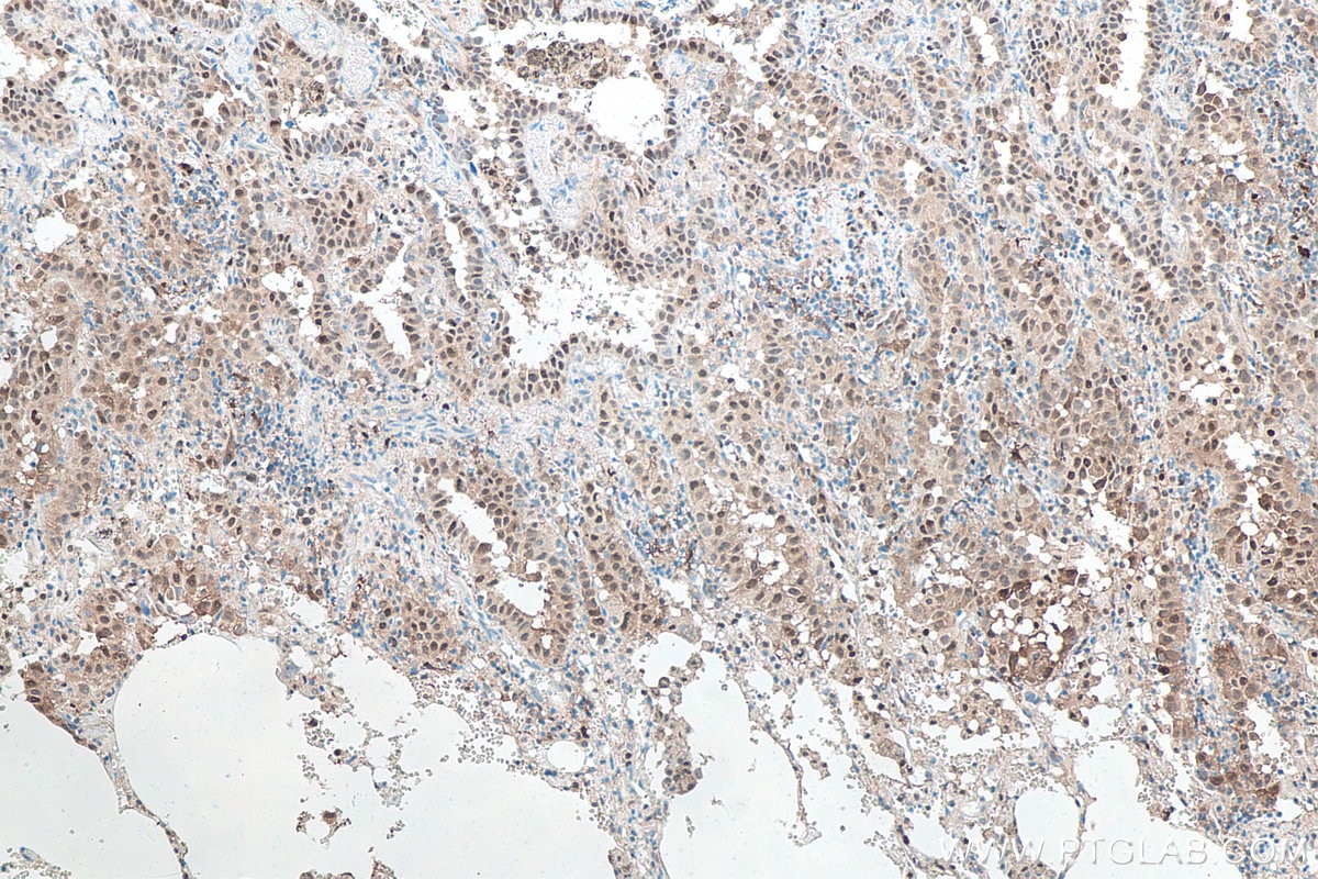 Immunohistochemistry (IHC) staining of human lung cancer tissue using P62,SQSTM1 Monoclonal antibody (66184-1-Ig)
