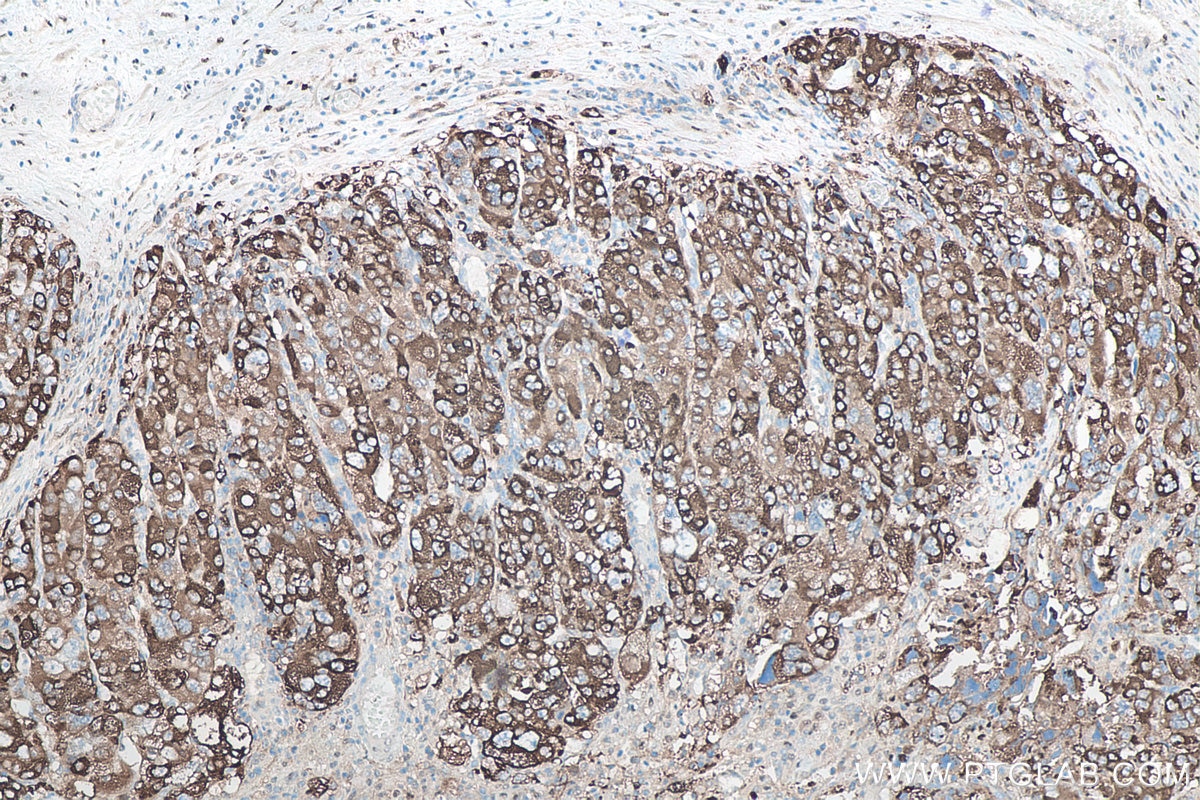 Immunohistochemistry (IHC) staining of human liver cancer tissue using P62,SQSTM1 Monoclonal antibody (66184-1-Ig)