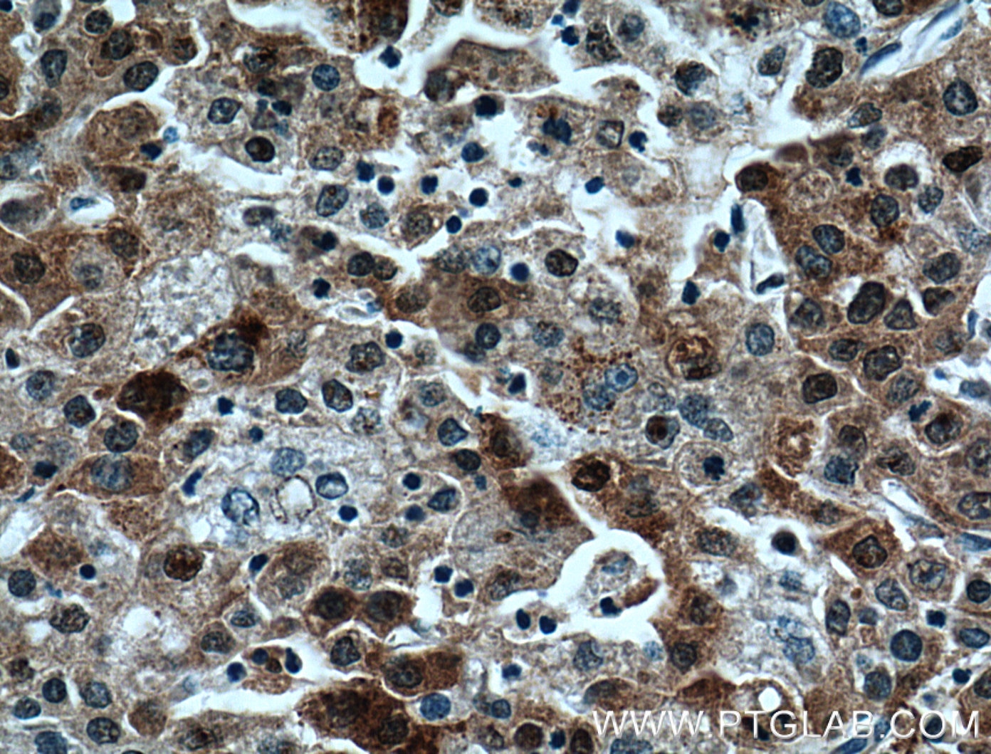 Immunohistochemistry (IHC) staining of human liver cancer tissue using P62,SQSTM1 Monoclonal antibody (66184-1-Ig)