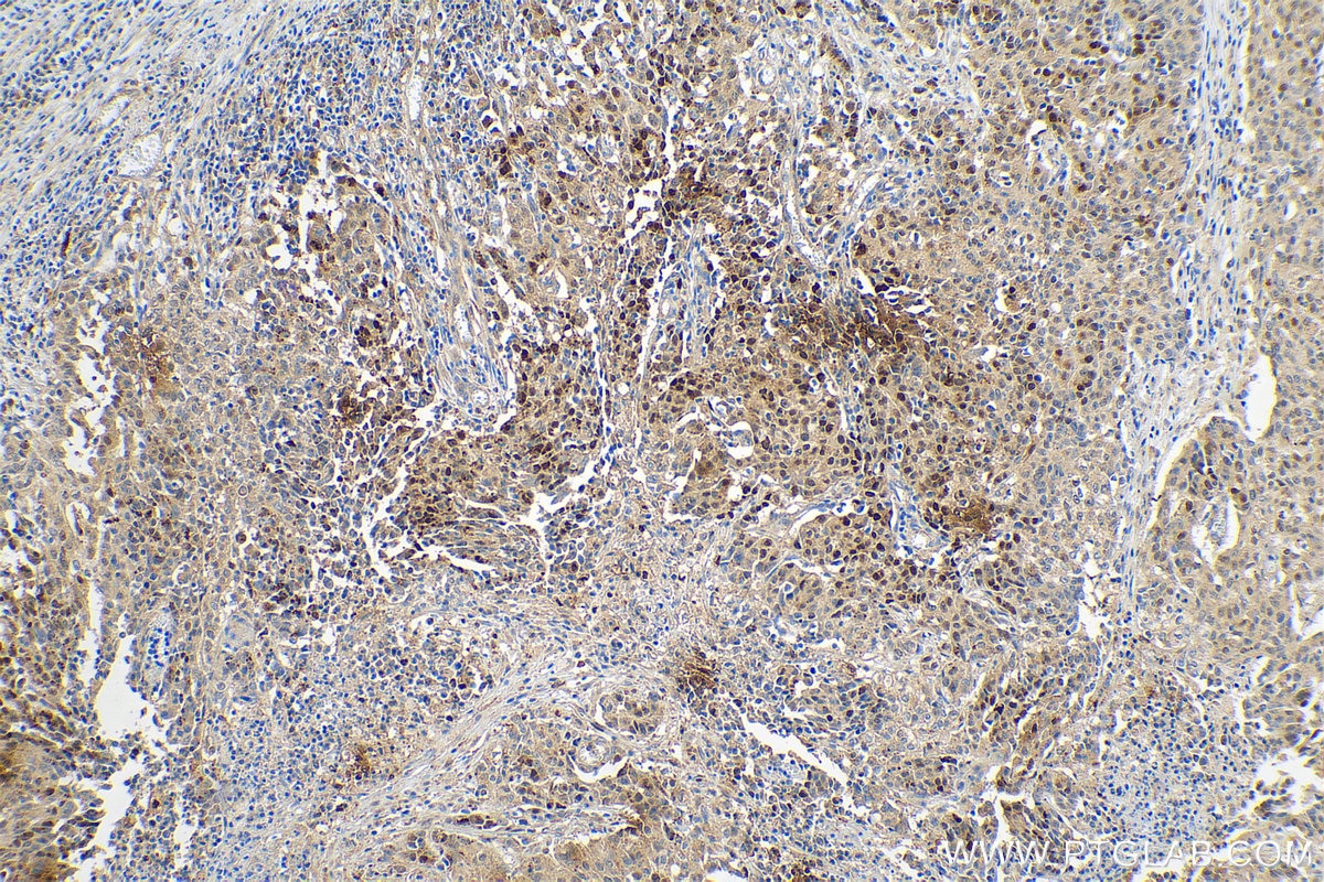 Immunohistochemistry (IHC) staining of human stomach cancer tissue using P62,SQSTM1 Recombinant antibody (80294-1-RR)