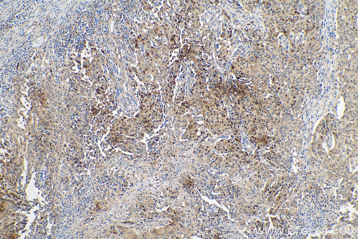 IHC staining of human stomach cancer using 80294-1-RR