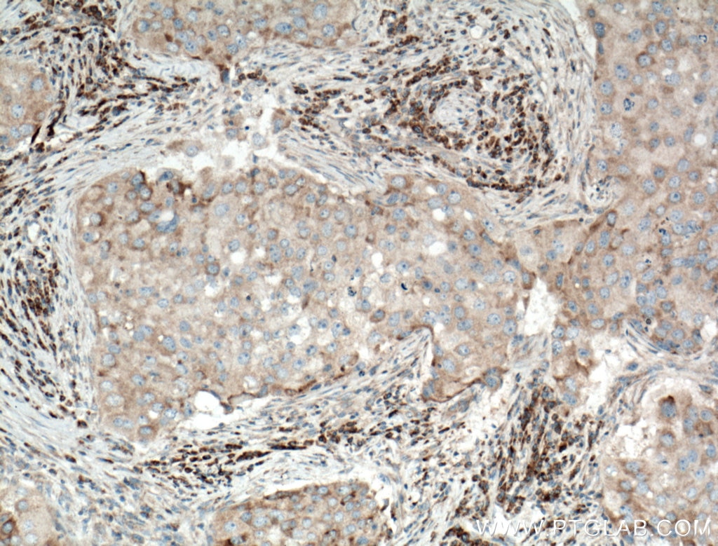Immunohistochemistry (IHC) staining of human breast cancer tissue using PA2G4 Polyclonal antibody (15348-1-AP)