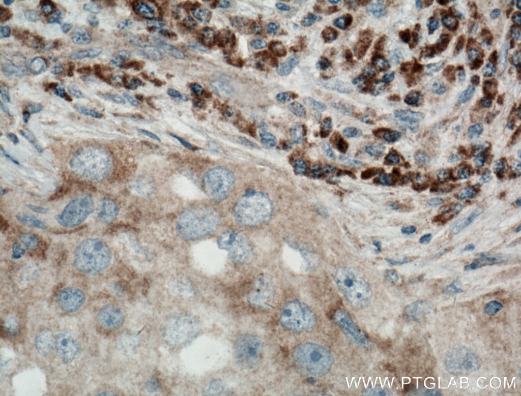 Immunohistochemistry (IHC) staining of human breast cancer tissue using PA2G4 Polyclonal antibody (15348-1-AP)