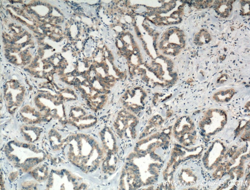 Immunohistochemistry (IHC) staining of human breast cancer tissue using PA2G4 Monoclonal antibody (66055-1-Ig)
