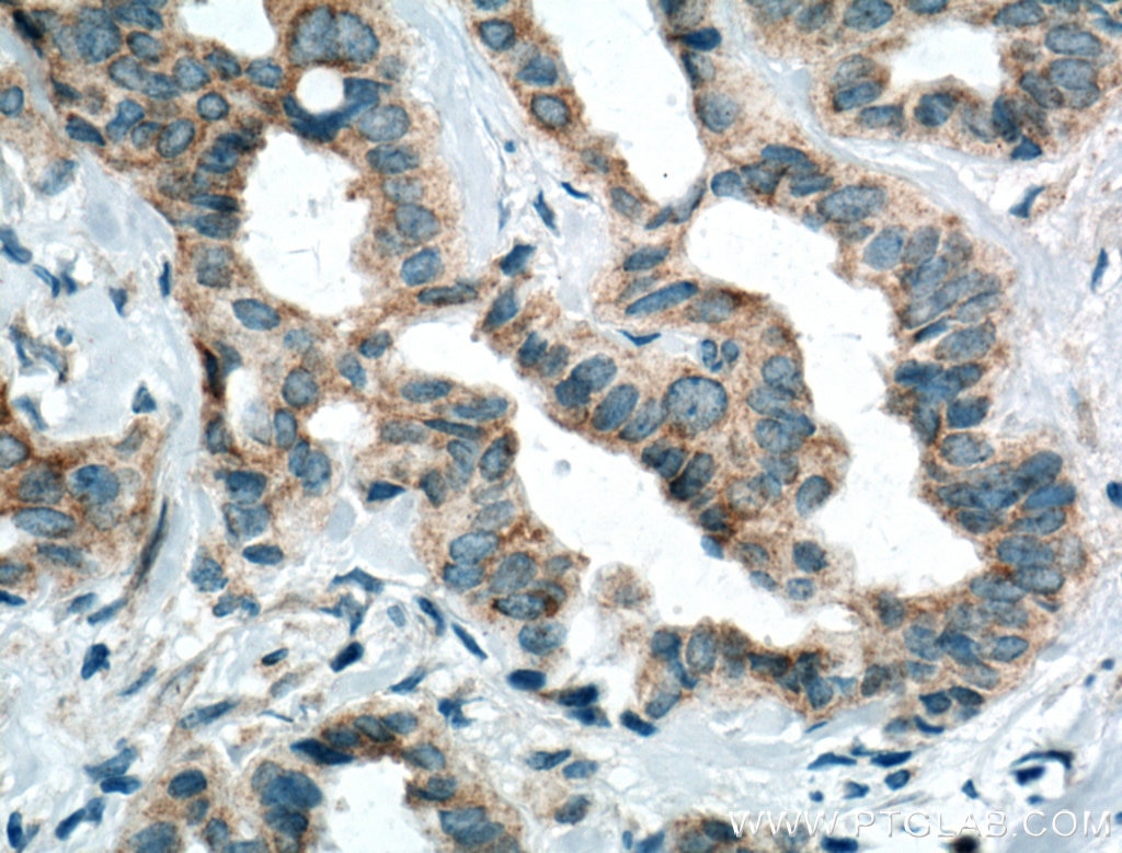 Immunohistochemistry (IHC) staining of human breast cancer tissue using PA2G4 Monoclonal antibody (66055-1-Ig)