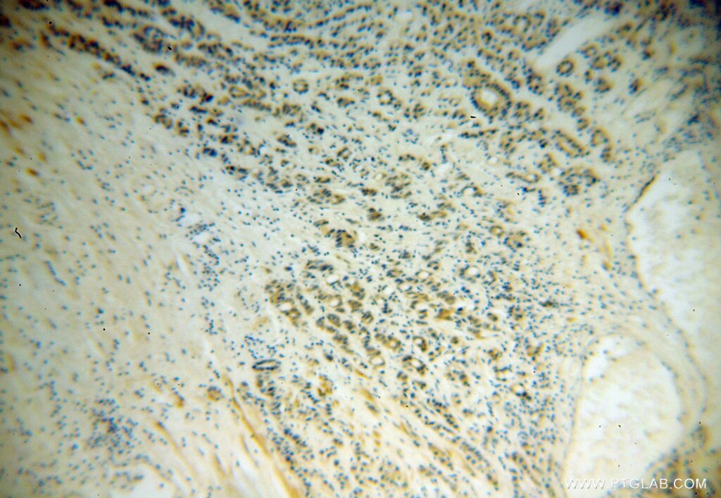 Immunohistochemistry (IHC) staining of human gliomas tissue using PABPC4 Polyclonal antibody (14960-1-AP)