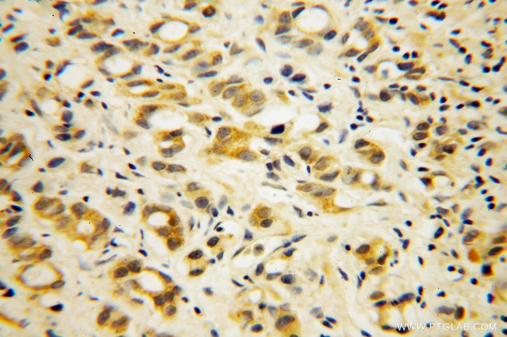 Immunohistochemistry (IHC) staining of human gliomas tissue using PABPC4 Polyclonal antibody (14960-1-AP)