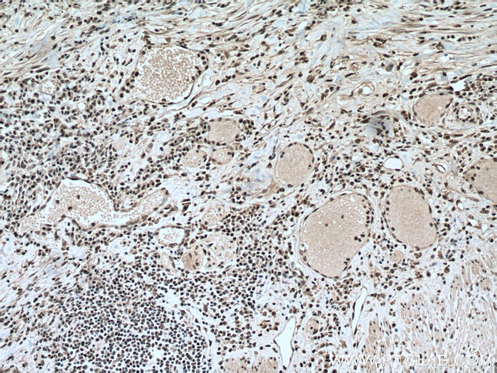 Immunohistochemistry (IHC) staining of human colon cancer tissue using PABPN1 Monoclonal antibody (66807-1-Ig)