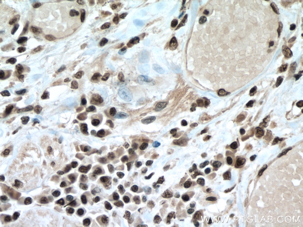 IHC staining of human colon cancer using 66807-1-Ig