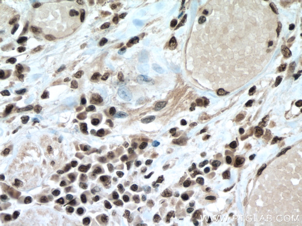 Immunohistochemistry (IHC) staining of human colon cancer tissue using PABPN1 Monoclonal antibody (66807-1-Ig)