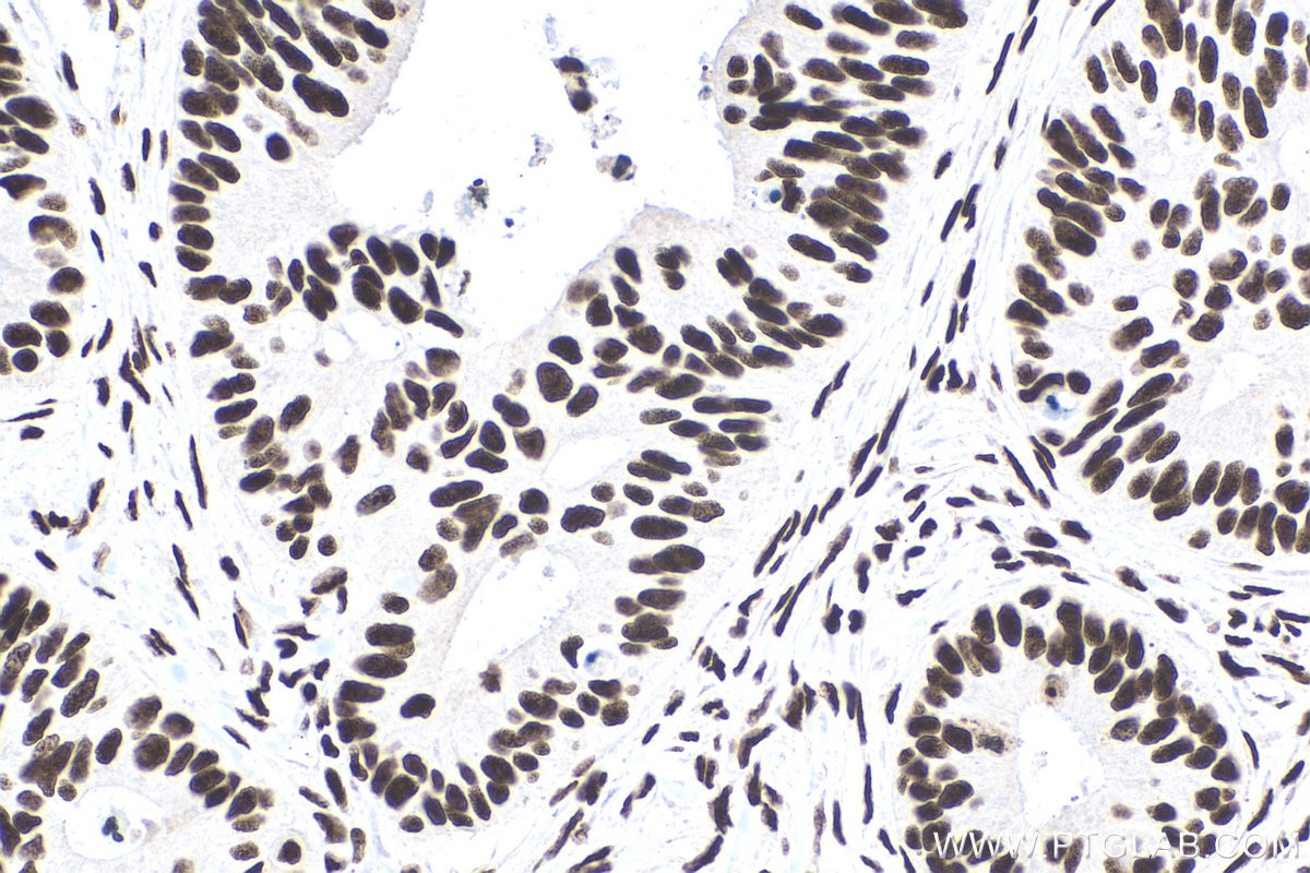 Immunohistochemistry (IHC) staining of human colon cancer tissue using PABPN1 Monoclonal antibody (66807-1-Ig)
