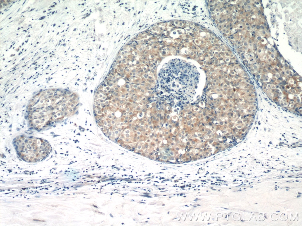 Immunohistochemistry (IHC) staining of human breast cancer tissue using PACSIN2 Polyclonal antibody (10518-2-AP)