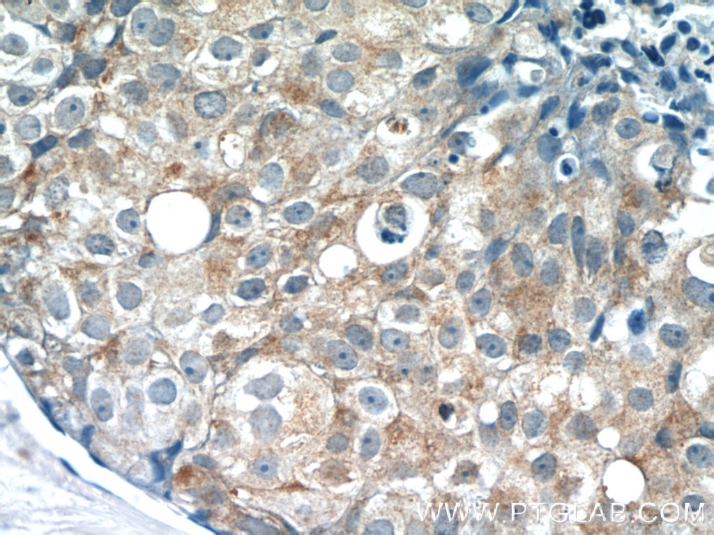 Immunohistochemistry (IHC) staining of human breast cancer tissue using PACSIN2 Polyclonal antibody (10518-2-AP)