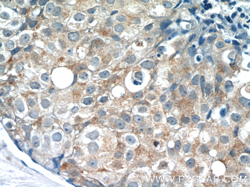 IHC staining of human breast cancer using 10518-2-AP