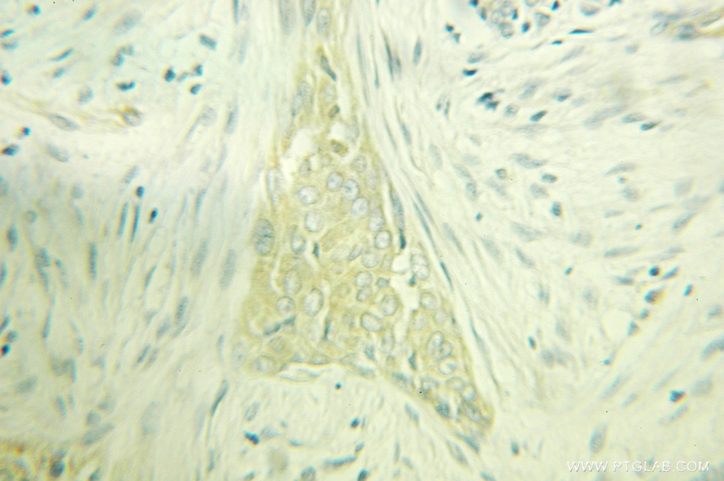 Immunohistochemistry (IHC) staining of human breast cancer tissue using PACSIN2 Polyclonal antibody (10518-2-AP)