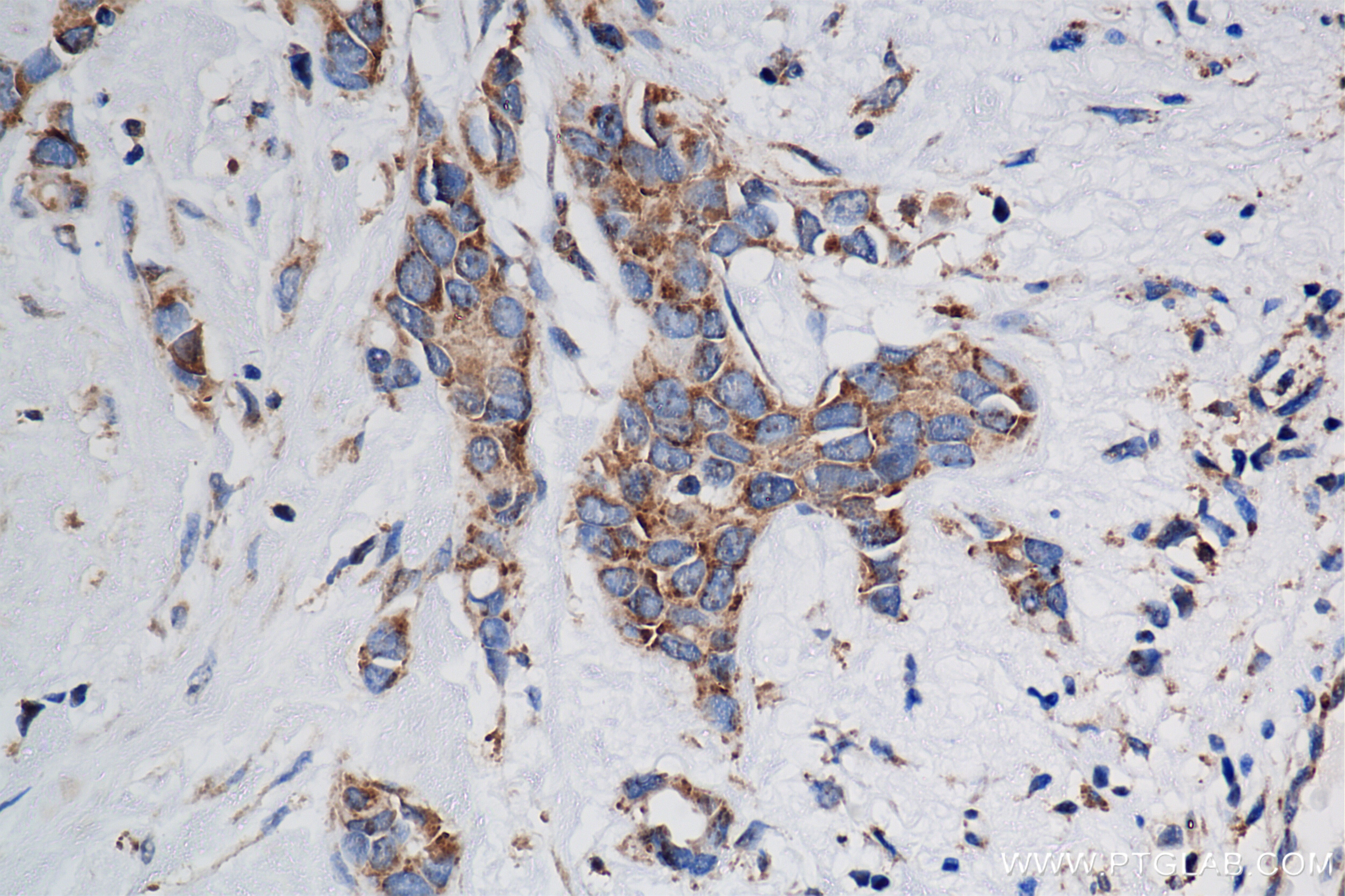Immunohistochemistry (IHC) staining of human breast cancer tissue using PACSIN2 Recombinant antibody (84763-4-RR)