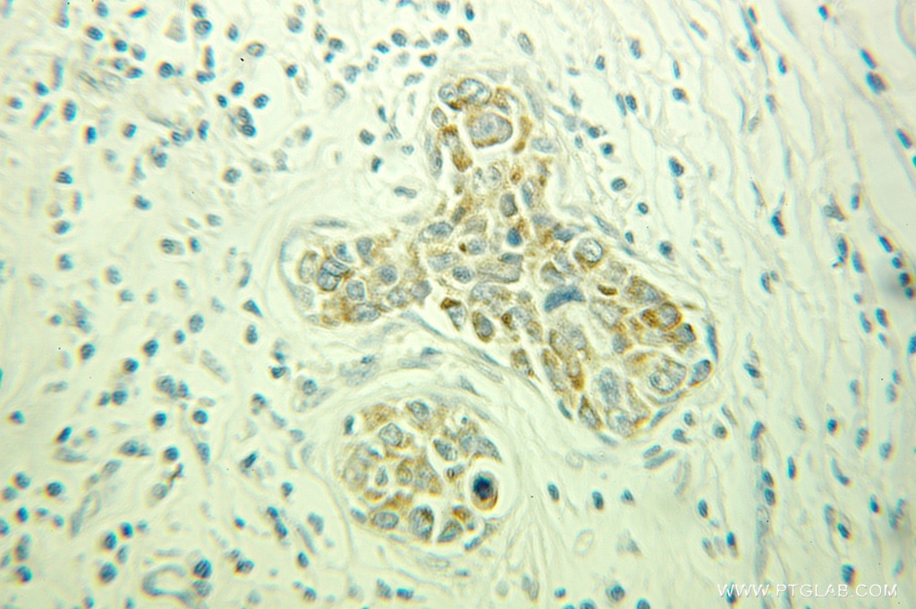 Immunohistochemistry (IHC) staining of human breast cancer tissue using PACSIN3 Polyclonal antibody (10639-1-AP)
